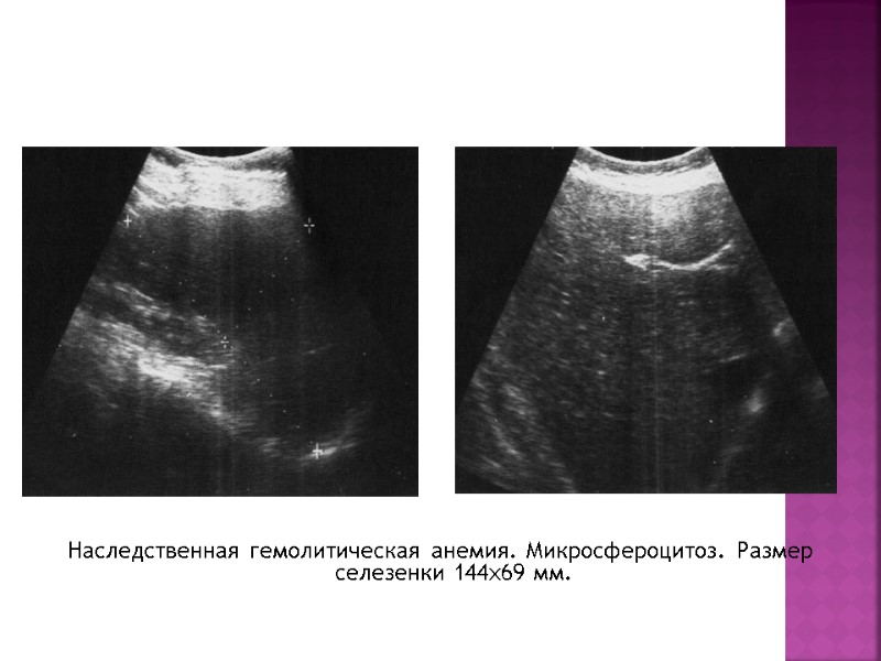Наследственная гемолитическая анемия. Микросфероцитоз. Размер селезенки 144х69 мм.
